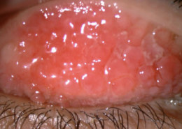 How to treat and why they reoccurs