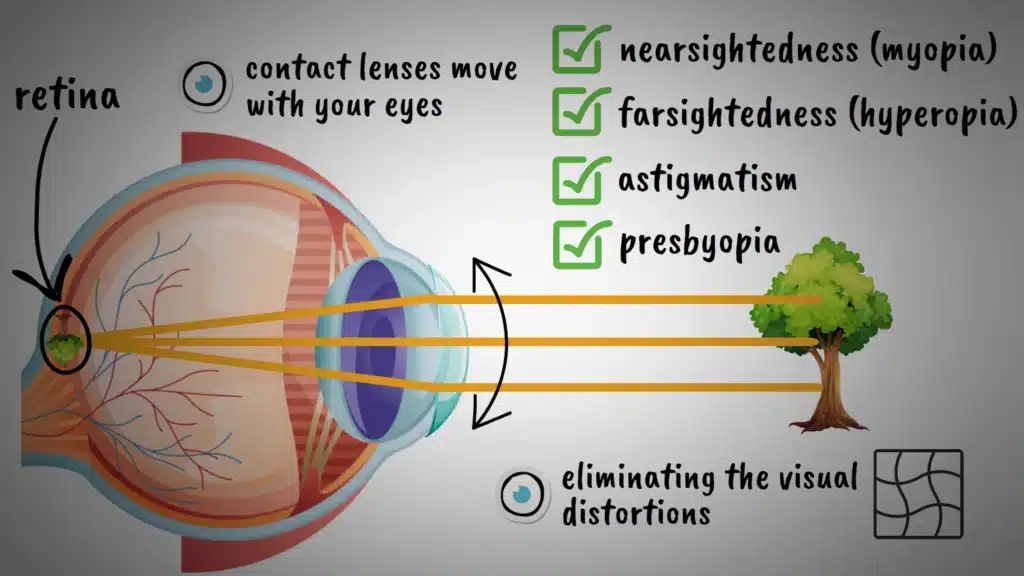 Contact lenses explained