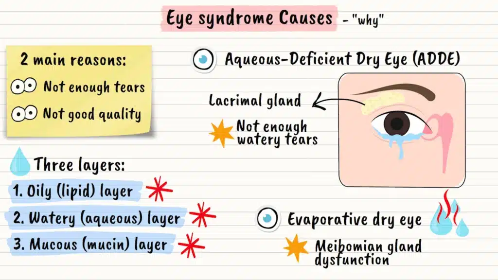 Causes for dry eye syndrome