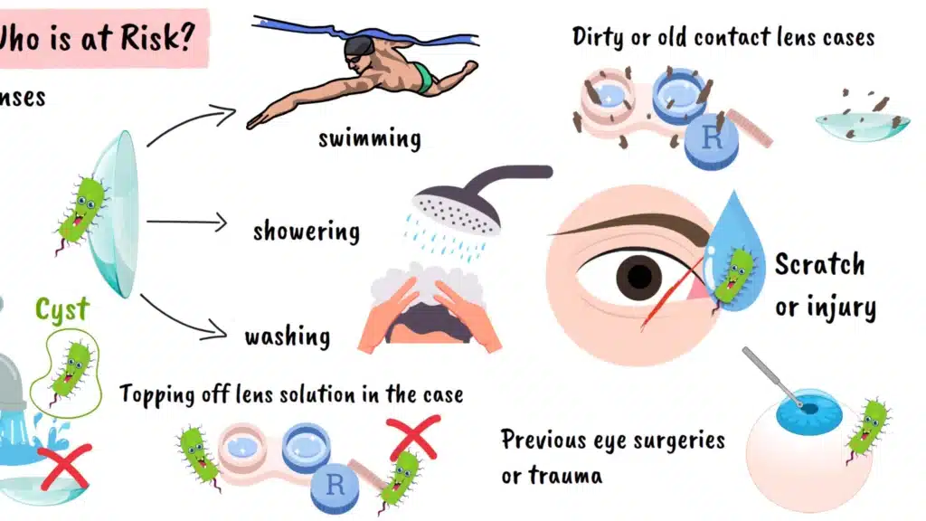 Acanthamoeba Keratitis more risk factors