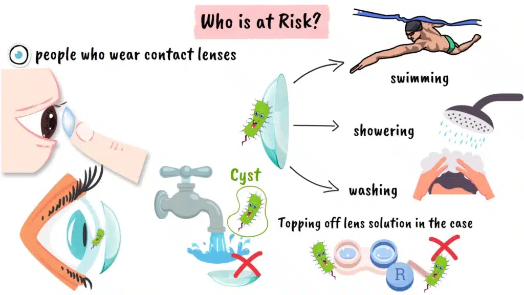 Acanthamoeba Keratitis risk factors