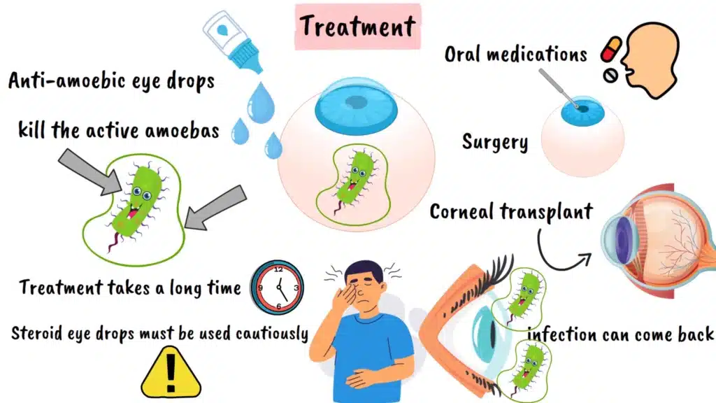 Acanthamoeba Keratitis treatment