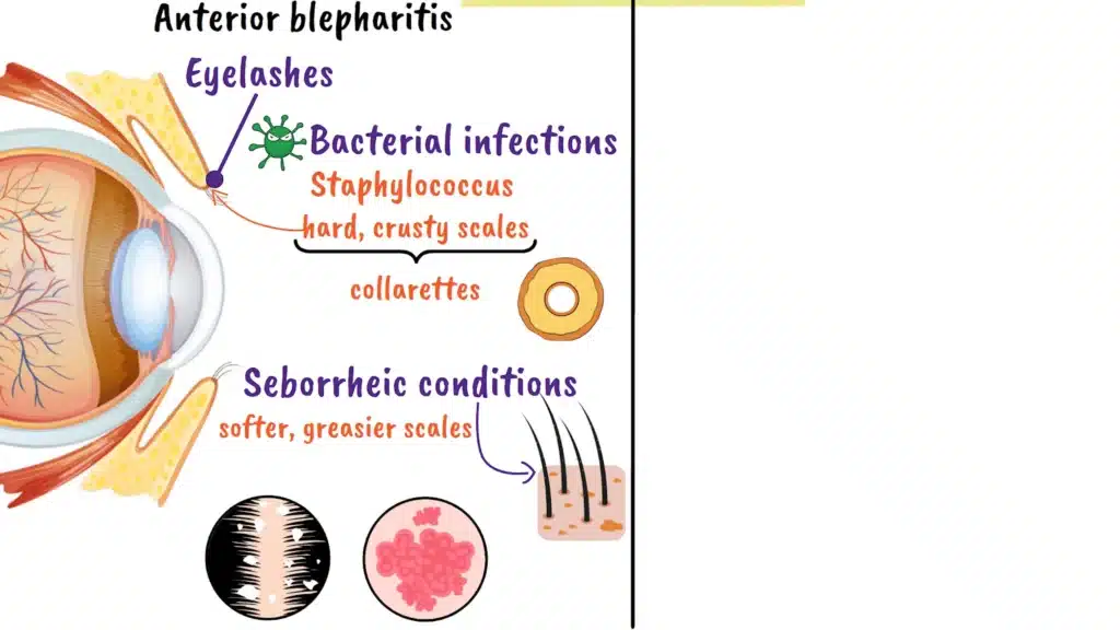 Anterior Blepharitis