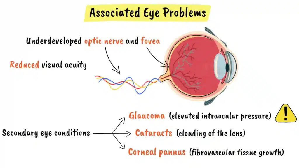 Associated eye problems with Aniridia