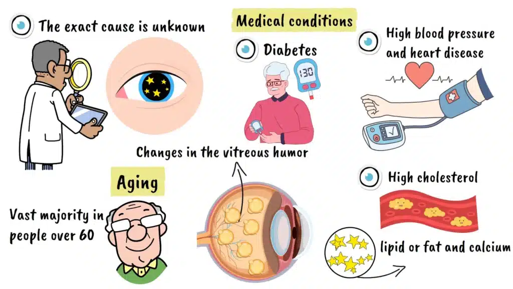 Asteroid Hyalosis causes