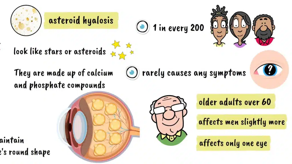Asteroid Hyalosis statistics