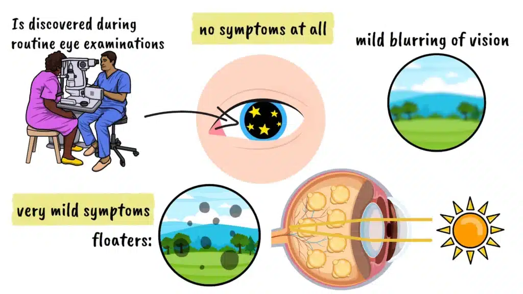 Asteroid Hyalosis symptoms