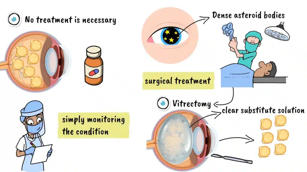 Asteroid Hyalosis treatment