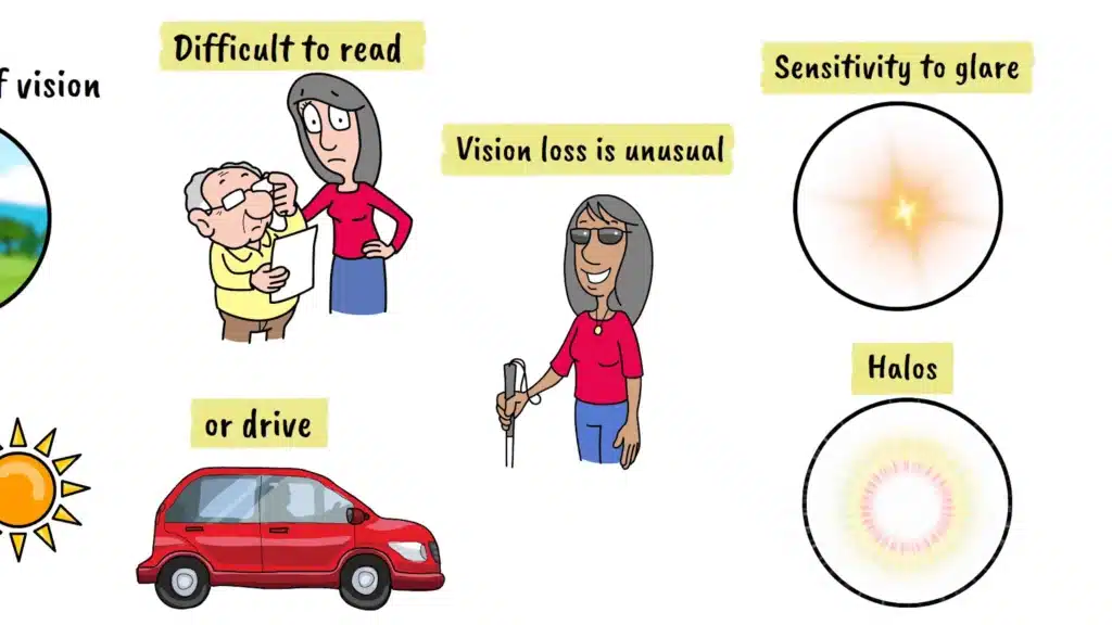 Asteroid Hyalosis vision impact