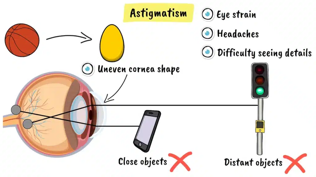 Astigmatism explained