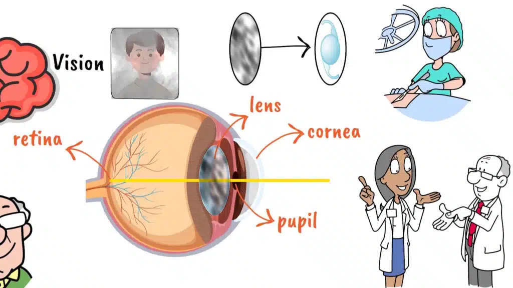 Cataract surgery eye anatomy