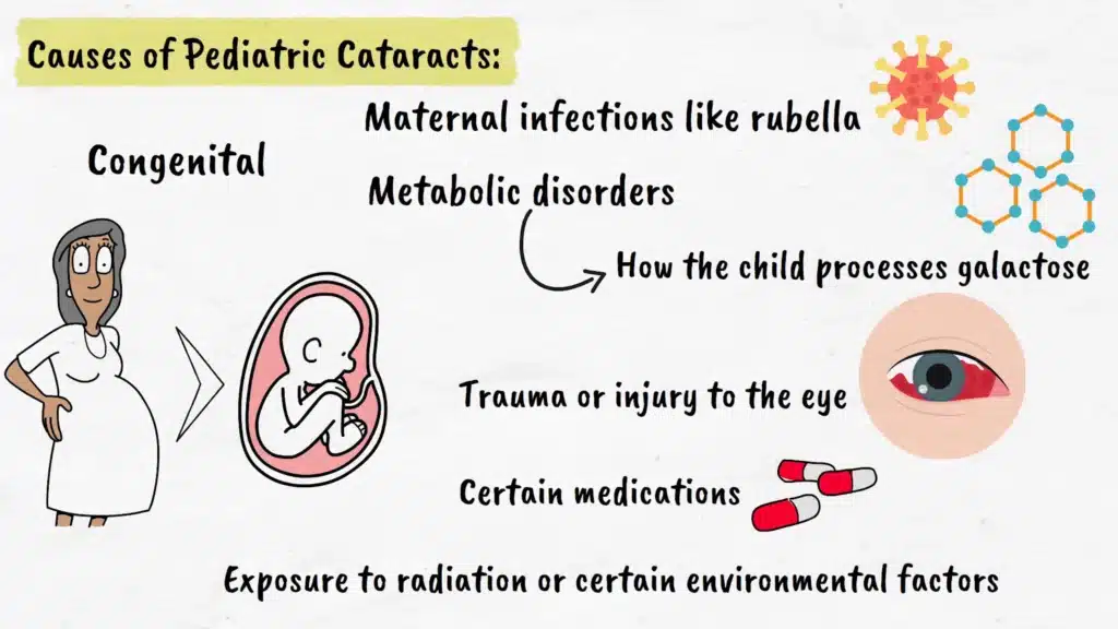 Cause of Pediatric Cataracts