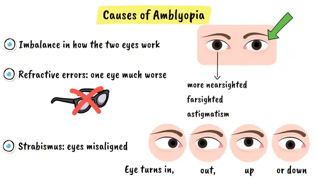 Causes of Amblyopia