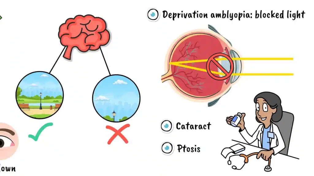 Causes of Amblyopia Cataract and ptosis