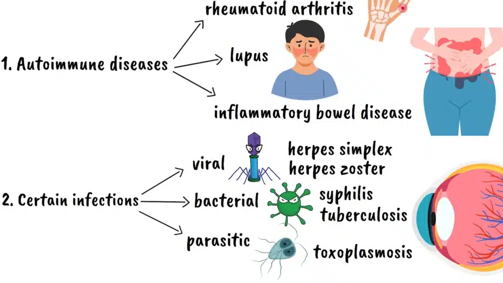 Causes of uveitis
