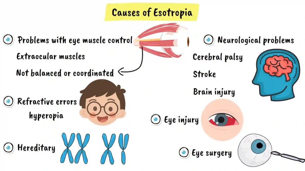 Causes of Esotropia