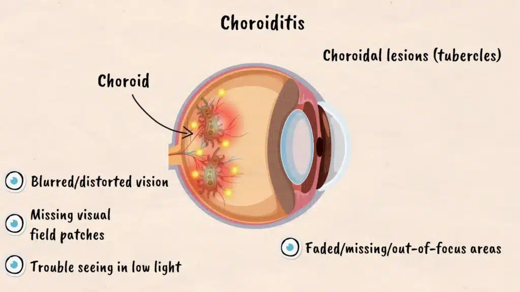Choroiditis explained