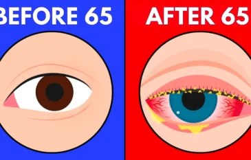 Eye Conditions After 65: What to Know