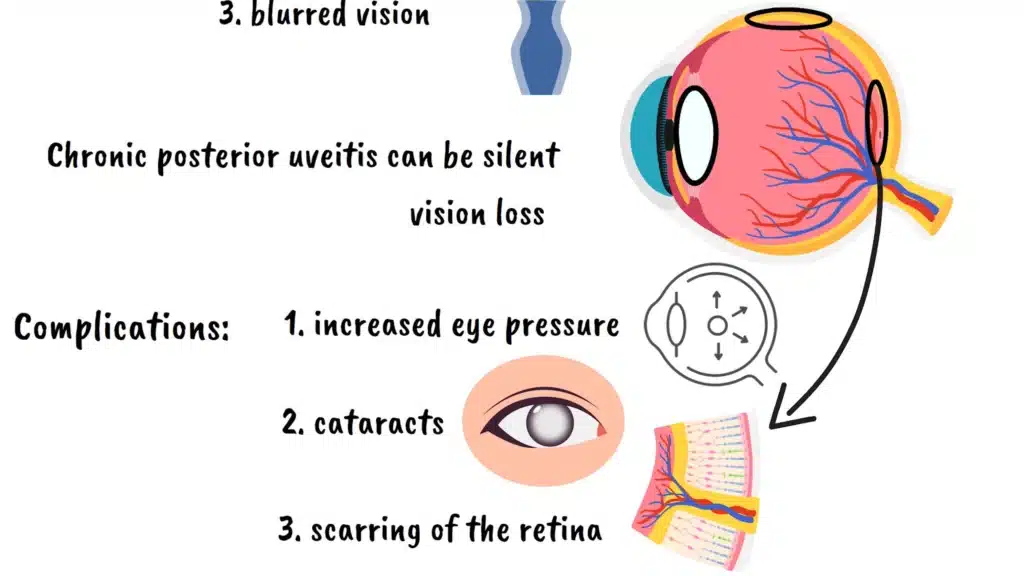 Complications of uveitis