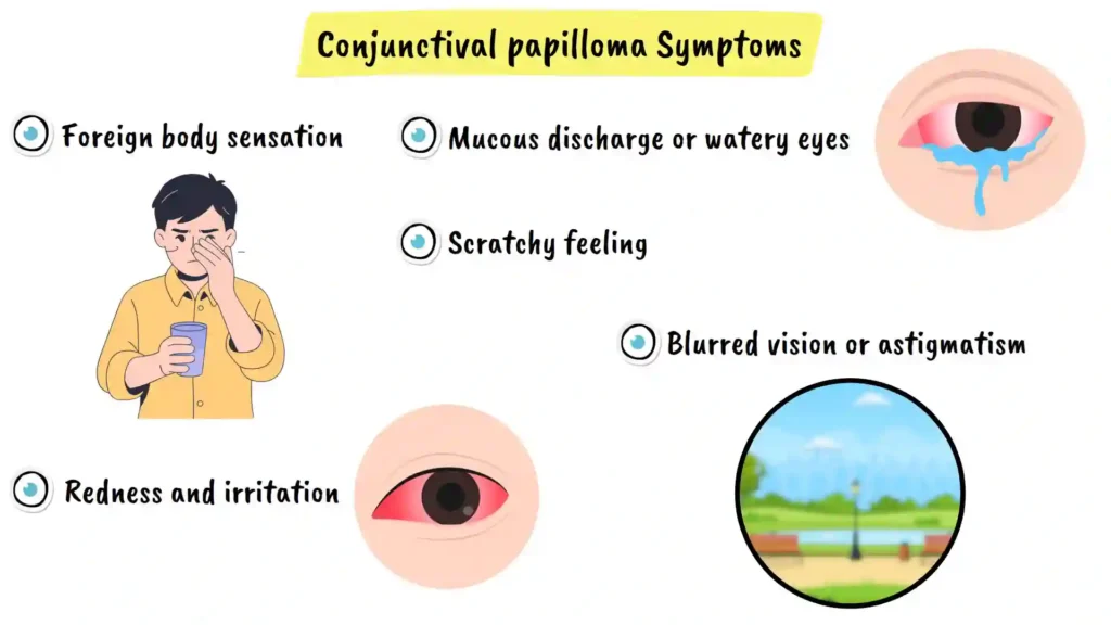 Conjunctival Papilloma Symptoms