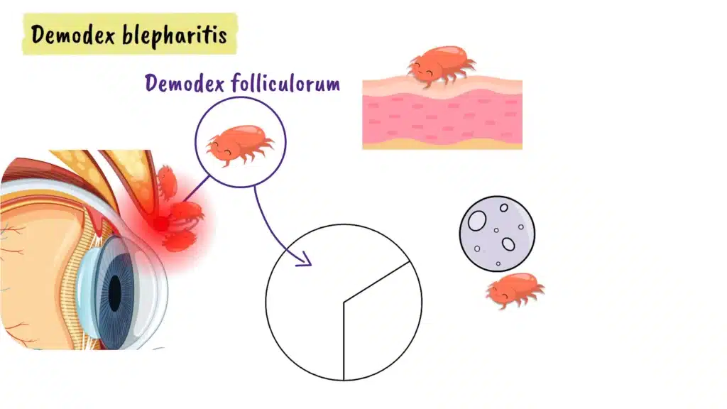 Demodex Blepharitis