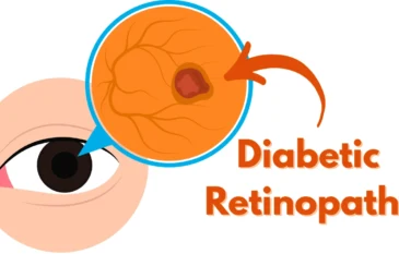 Diabetic Retinopathy Explained