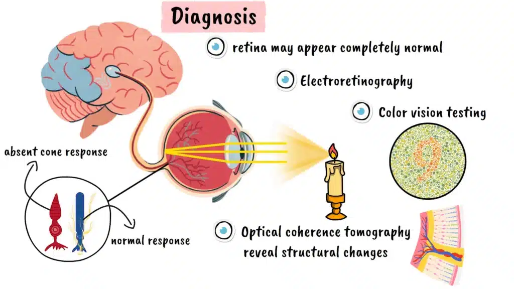 Diagnosis of Achromatopsia