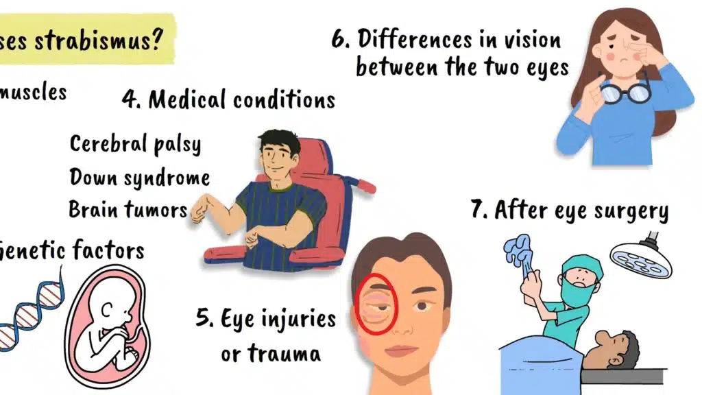 Different causes of strabismus
