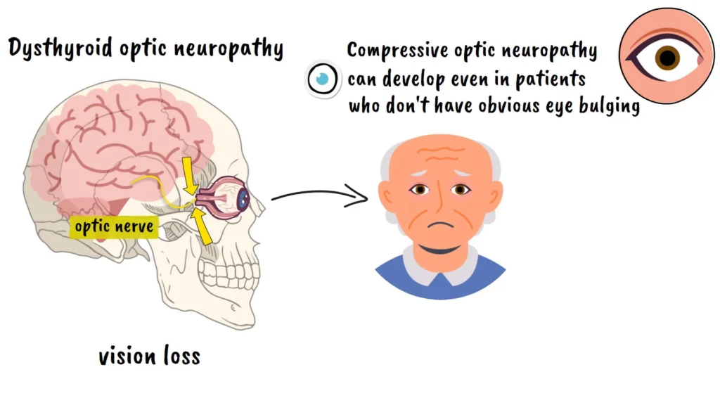 Dysthyroid Optic Neuropathy
