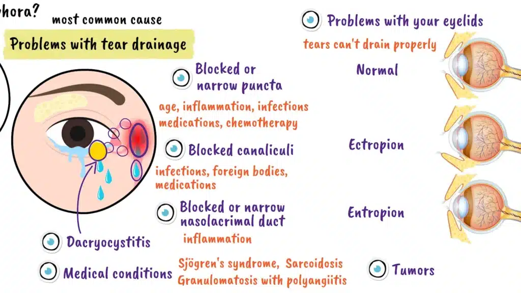 Epiphora causes