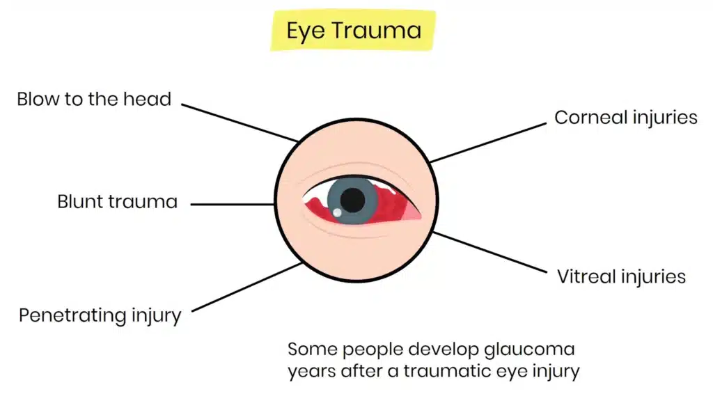 Eye trauma Glaucoma Risk Factors