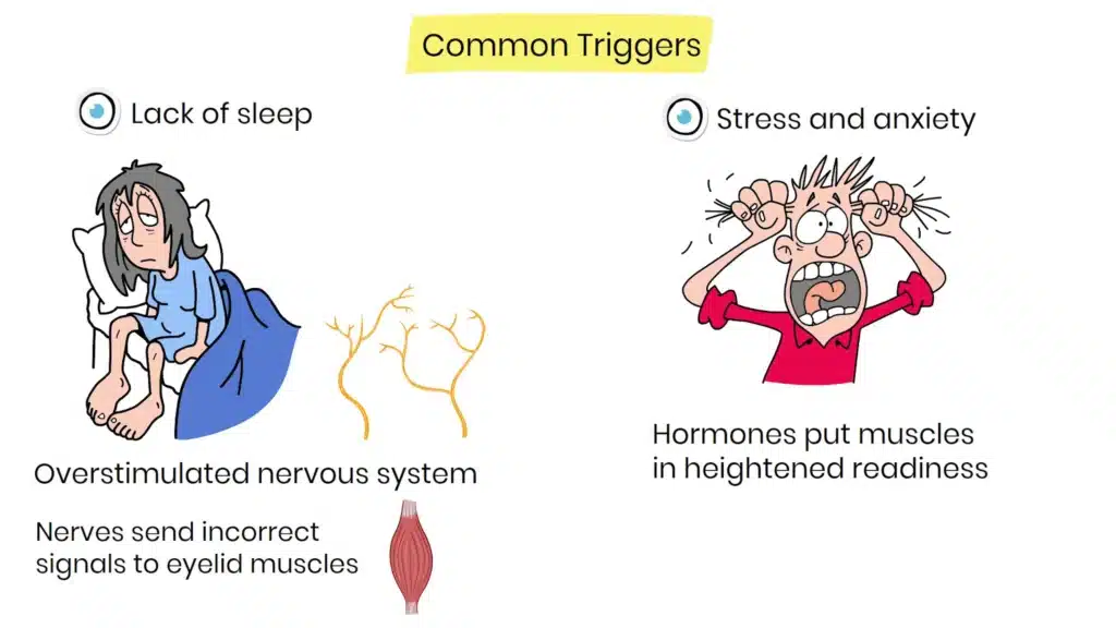 Eyelid Twitching lack of sleep and stress and anxiety