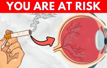 Glaucoma: Risk Factors & Prevention