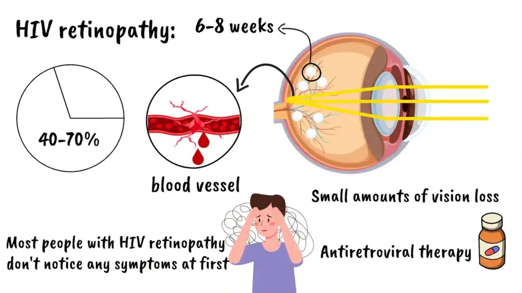 HIV retinopathy clinical image