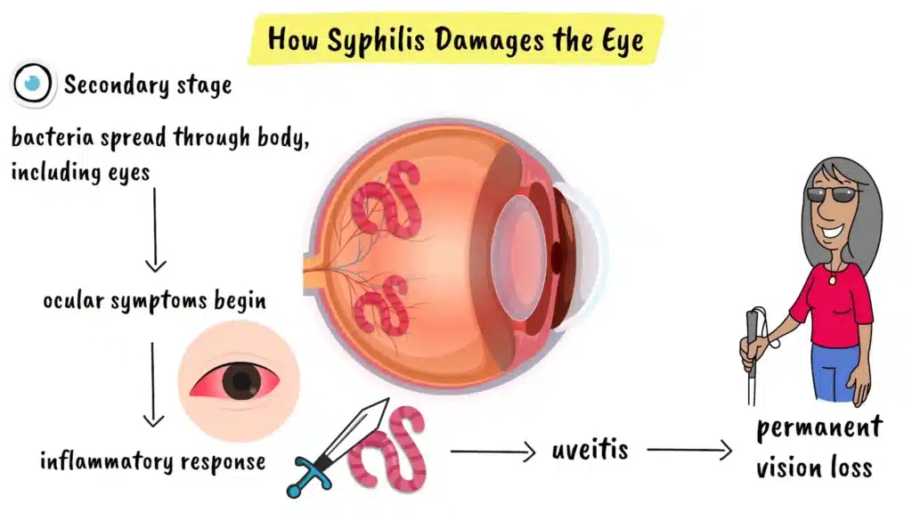 How Syphilis damages the eye