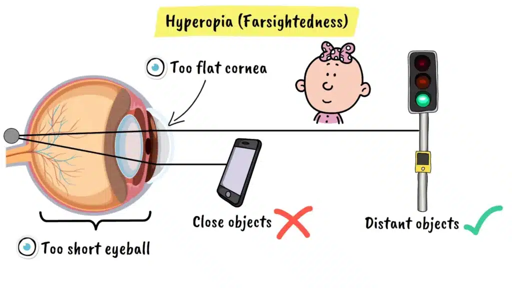 Hyperopia (Farsightedness) explained