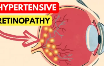 Hypertensive Retinopathy Explained