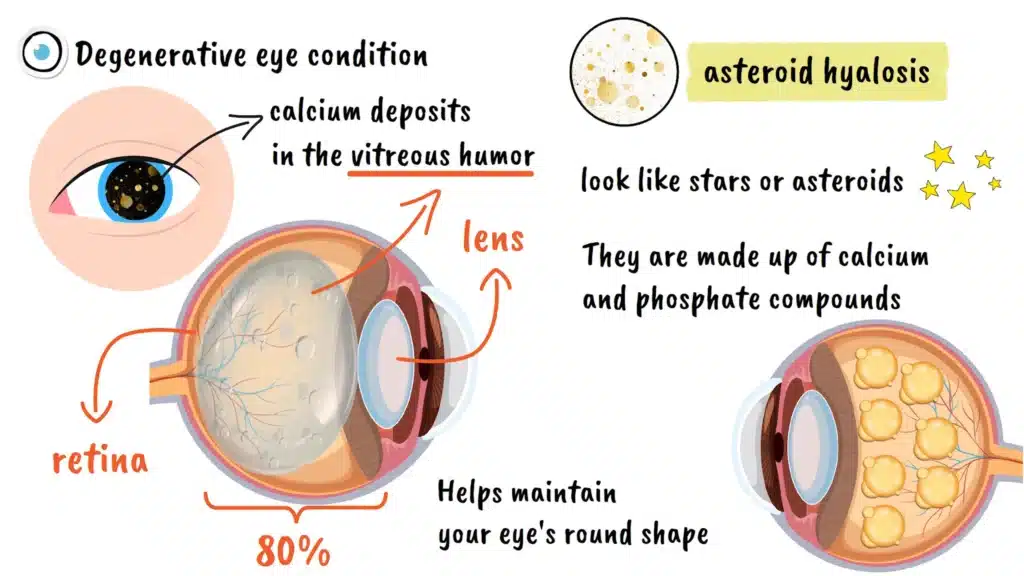 Intro to Asteroid Hyalosis