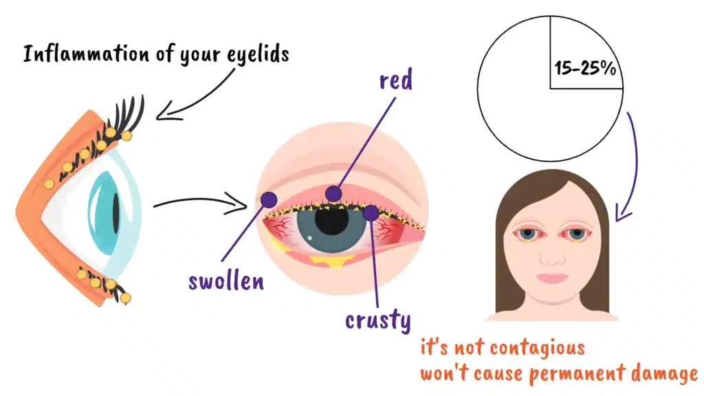 Intro to Blepharitis