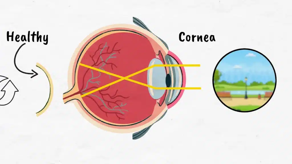 Intro to Corneal Transplant