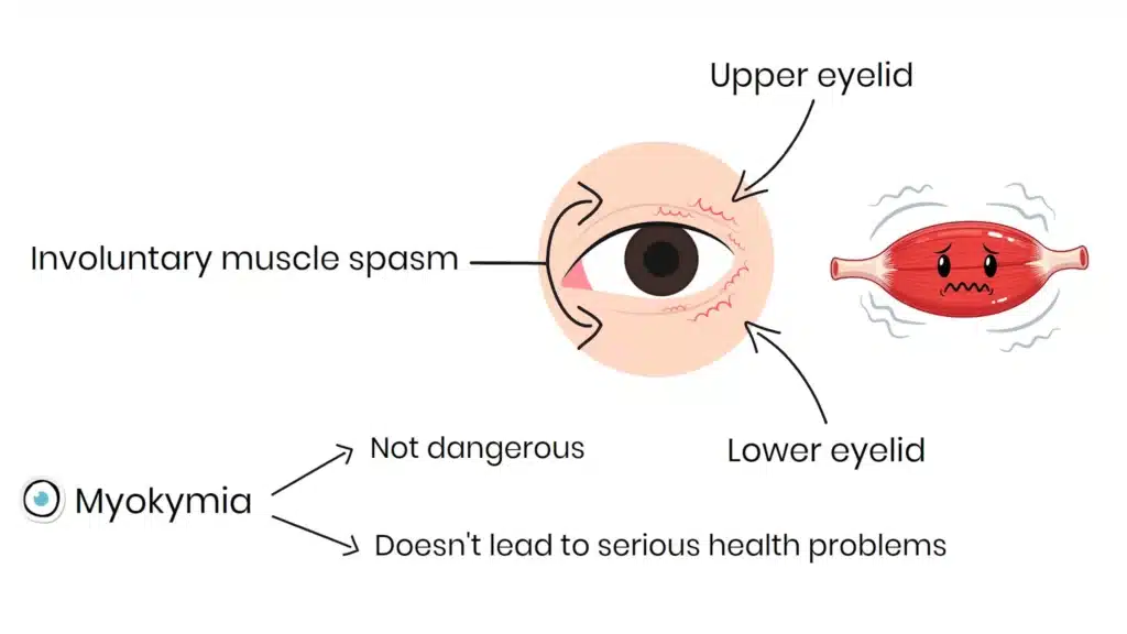 Intro to Eyelid Twitching - myokymia