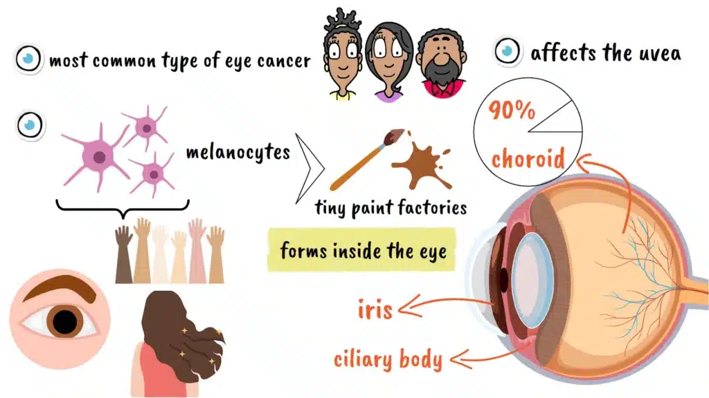 Intro to Ocular Melanoma