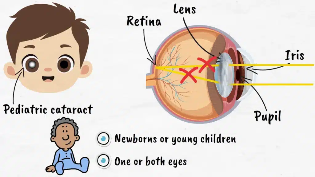 Intro to Pediatric Cataracts
