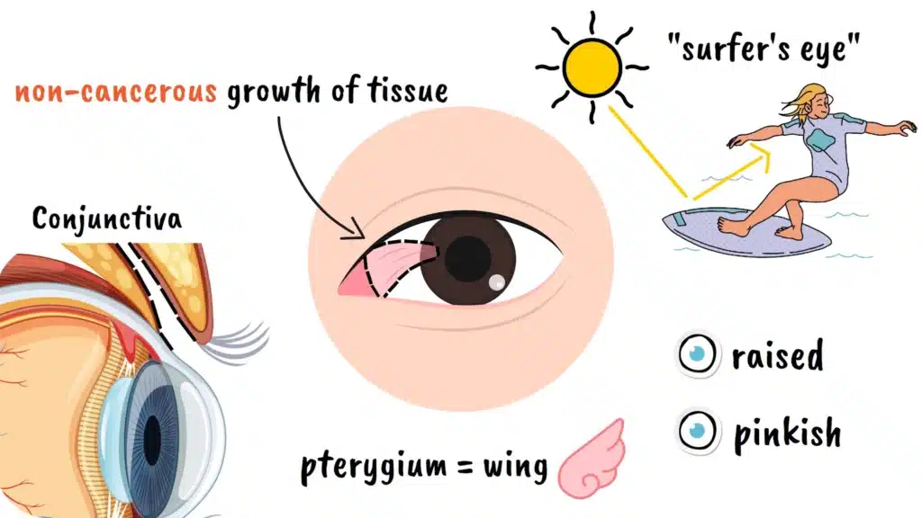 Intro to Pterygium