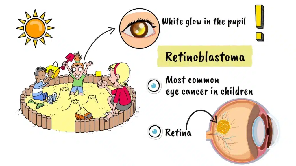 Intro to Retinoblastoma
