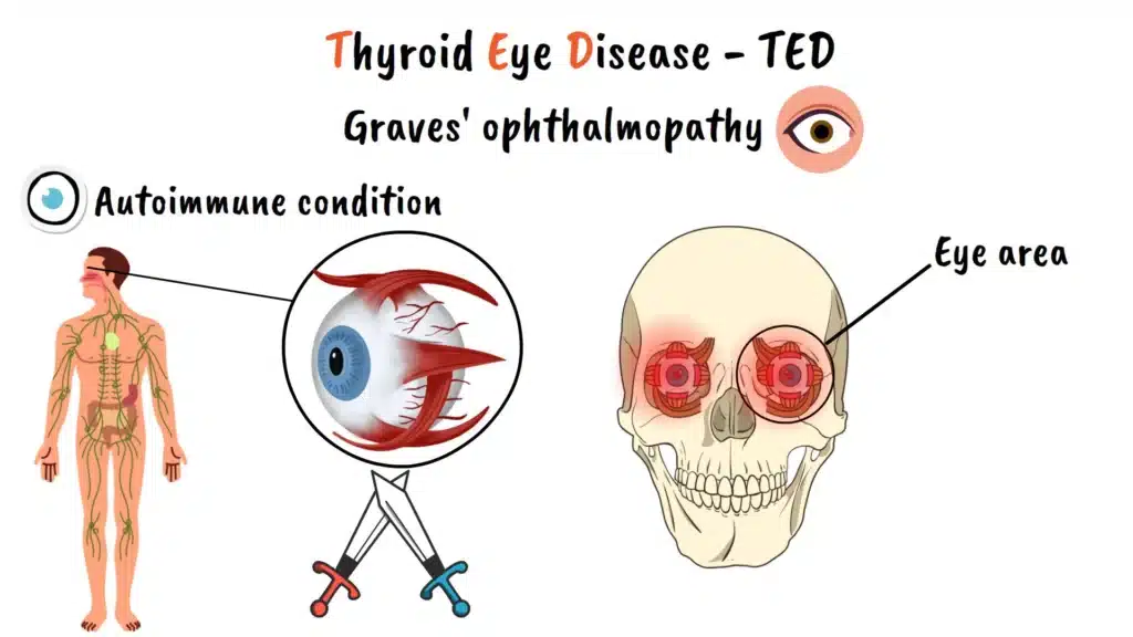 Intro to Thyroid Eye Disease
