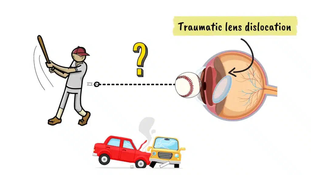Intro to Traumatic Lens Dislocation