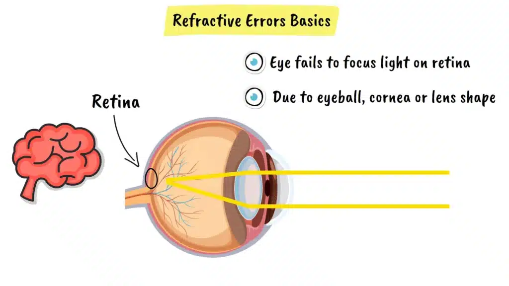 Intro to refractive errors