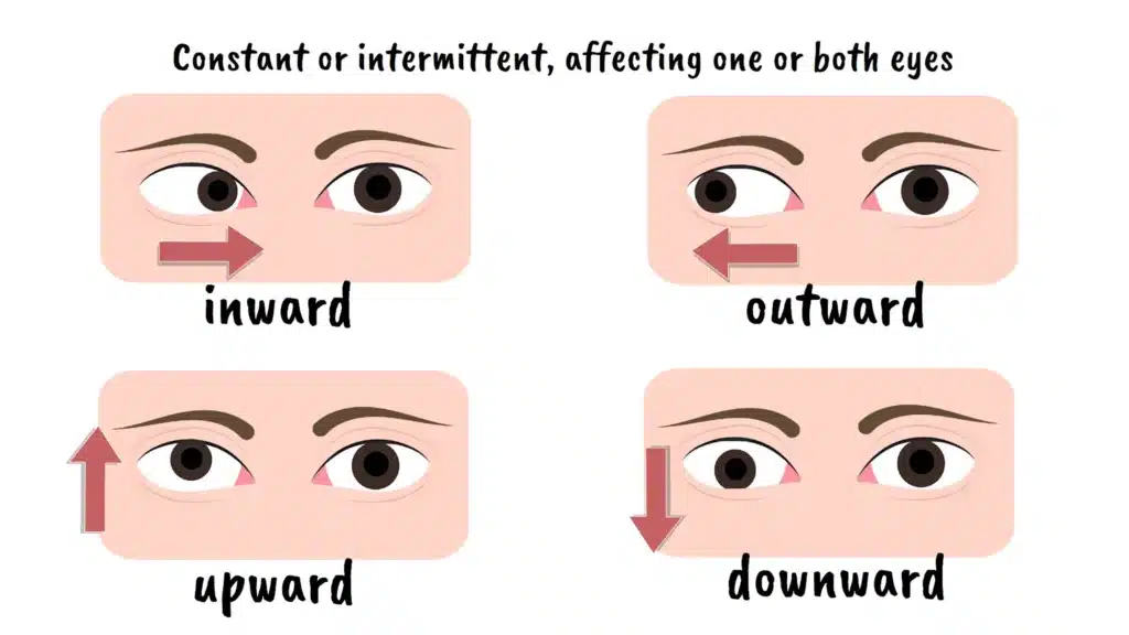 Intro to strabismus
