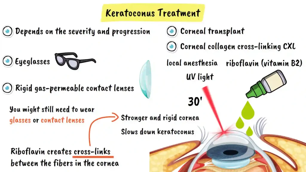 Keratoconus Treatment